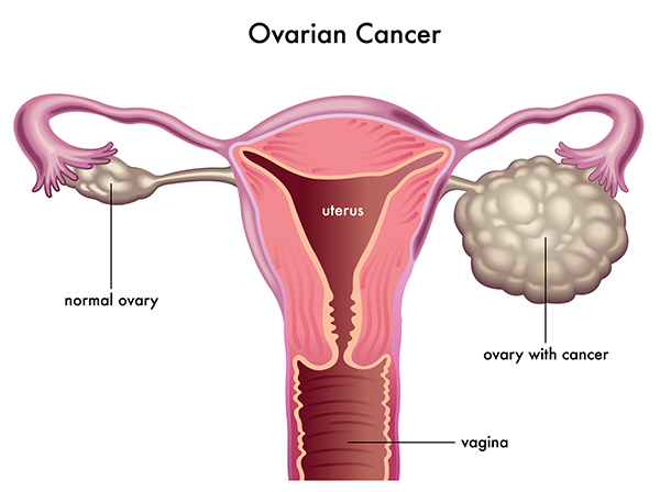 Ovarian cancer - Hình ảnh minh họa