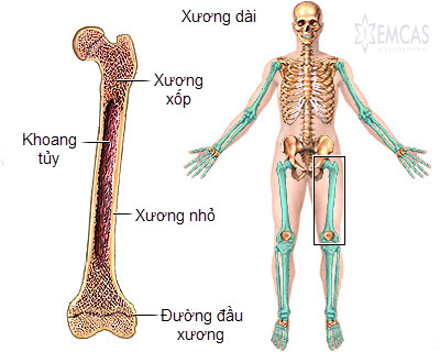 Bạch cầu tủy xương mạn tính (CML) - Hình ảnh minh họa