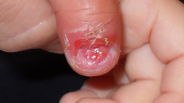 Bật móng tay - Hình ảnh minh họa