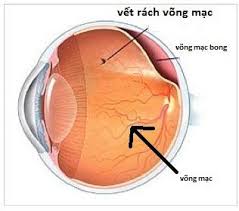 Bong võng mạc - Hình ảnh minh họa