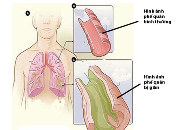 Bronchiectasis - Hình ảnh minh họa