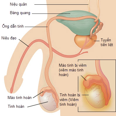 Orchitis - Hình ảnh minh họa