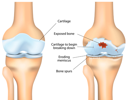 Osteoarthritis - Hình ảnh minh họa