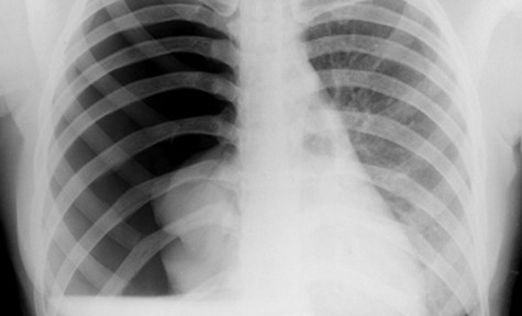 Pneumothorax - Hình ảnh minh họa