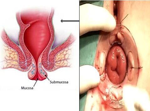 Prolapsus rectal - Hình ảnh minh họa
