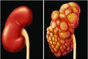 Polycystic Kidney Disease - Hình ảnh minh họa