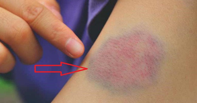 Bầm tím da - Hình ảnh minh họa