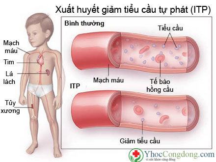Ban xuất huyết giảm tiểu cầu huyết khối - Hình ảnh minh họa