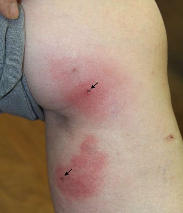 Bọ cạp đốt - Hình ảnh minh họa