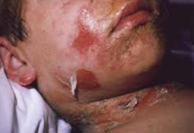 Bỏng da do tụ cầu - Hình ảnh minh họa