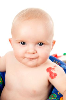 Bớt dâu tây - Hình ảnh minh họa