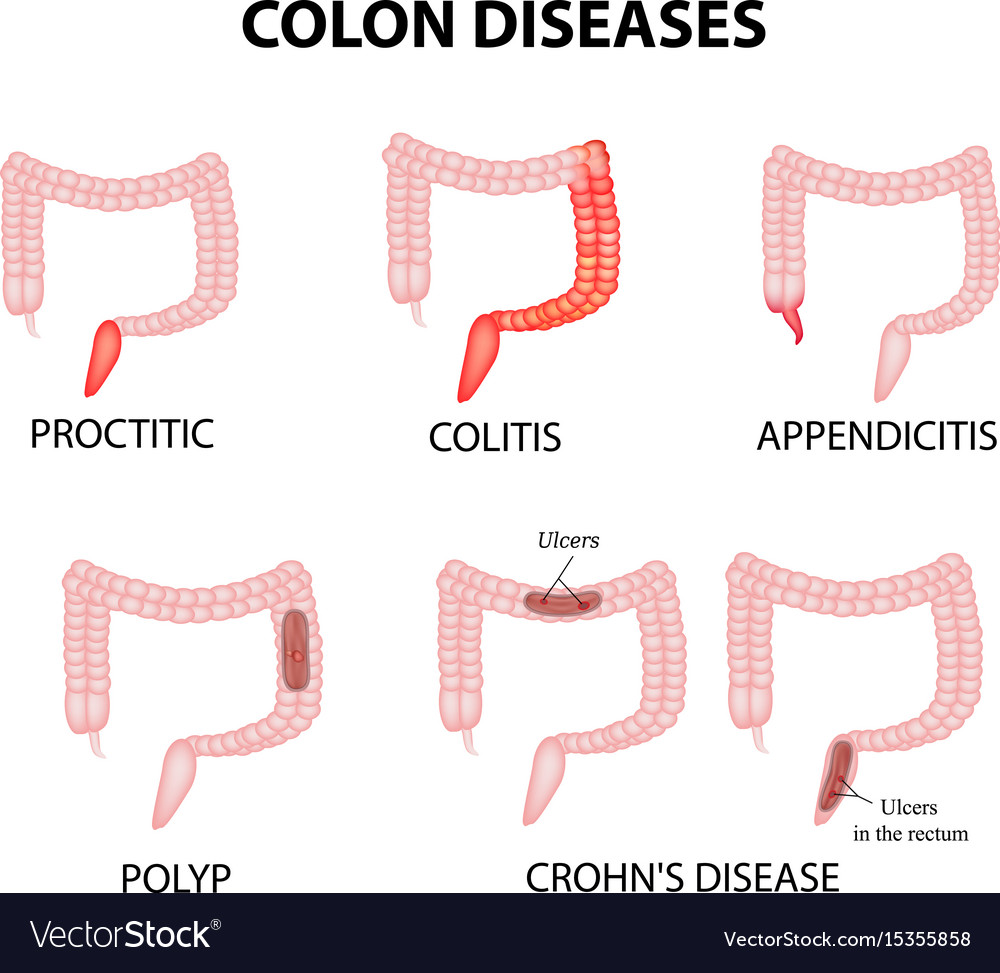 Proctitis - Hình ảnh minh họa