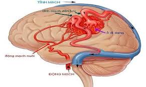 Brain arteriovenous malformation - Hình ảnh minh họa