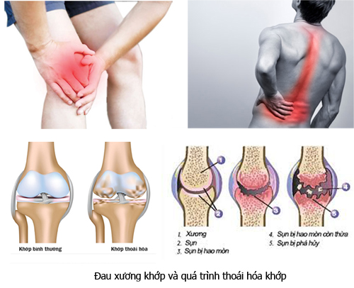 Pyogenic arthritis - Hình ảnh minh họa