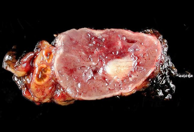 Pheochromocytoma - Hình ảnh minh họa