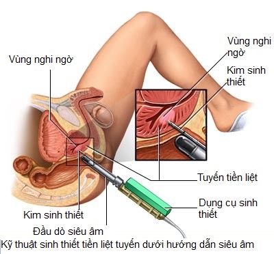Prostate Cancer - Hình ảnh minh họa