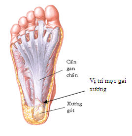 Plantar Fasciitis - Hình ảnh minh họa