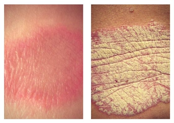 Pityriasis rosea - Hình ảnh minh họa