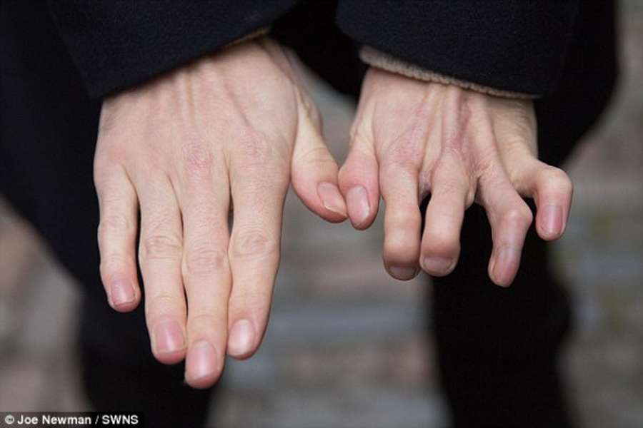 Biến dạng bàn tay - Hình ảnh minh họa