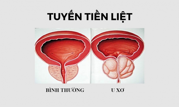Benign prostatic hyperplasia - Hình ảnh minh họa
