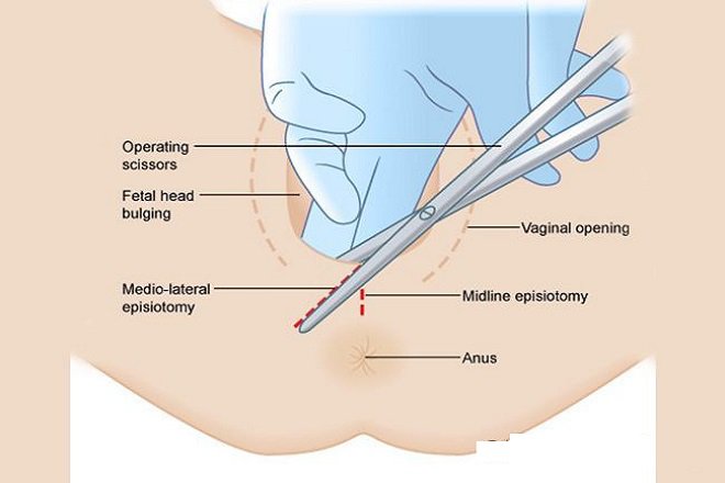 Tầng sinh môn những điều phụ nữ cần biết - ảnh 2
