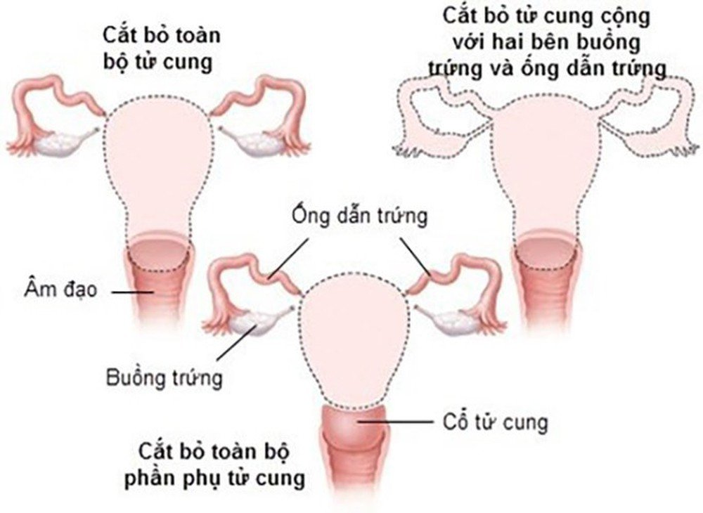 Cắt tử cung hoàn toàn qua nội soi - Thời gian hồi phục nhanh, không để lại sẹo xấu tr - ảnh 1