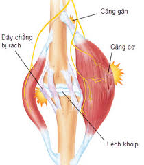 Căng cơ - Hình ảnh minh họa