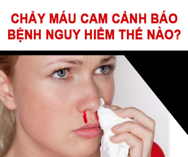 Chảy máu cam - Hình ảnh minh họa