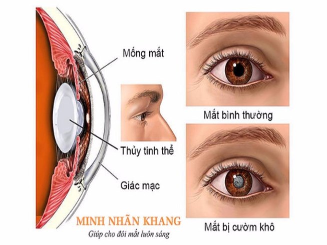 Cườm khô - Hình ảnh minh họa