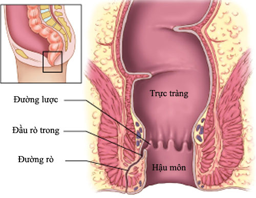 Phân khô cứng trong trực tràng - Hình ảnh minh họa
