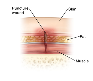Puncture Wound - Hình ảnh minh họa