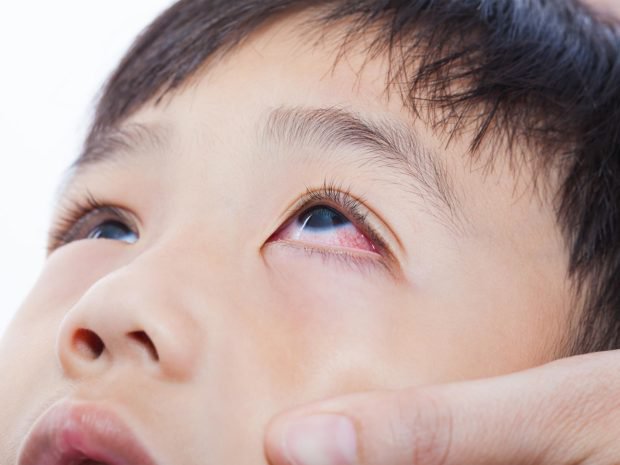 Viêm giác mạc: Nguyên nhân, triệu chứng, cách phòng tránh - ảnh 2
