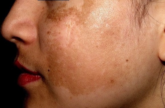 Rám má - Hình ảnh minh họa