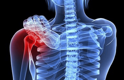 Paget xương - Hình ảnh minh họa