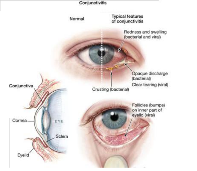 Conjunctivitis - Hình ảnh minh họa