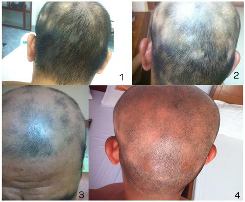 Rụng tóc từng mảng - Hình ảnh minh họa