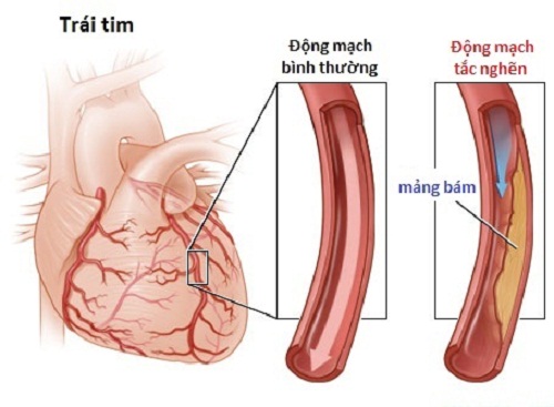 Peripheral arterial disease - Hình ảnh minh họa