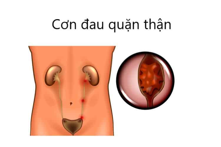 Cơn đau quặn thận - Hình ảnh minh họa