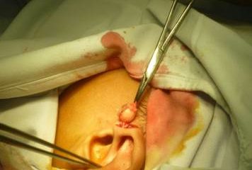 Rò luân nhĩ - Hình ảnh minh họa