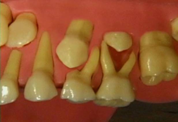 Răng thừa - Hình ảnh minh họa