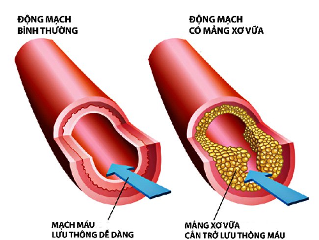 Cholesterol máu cao - Hình ảnh minh họa