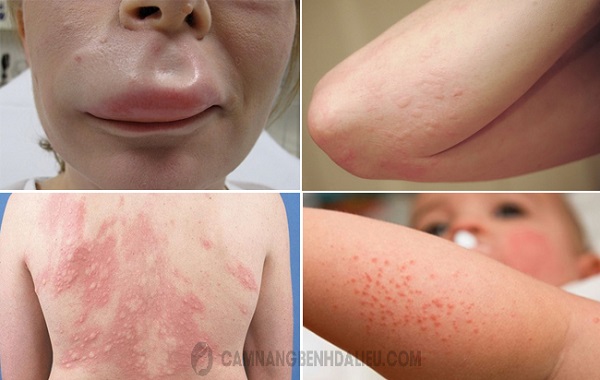 Phản ứng thuốc - Hình ảnh minh họa