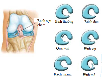 Rách sụn chêm đầu gối - Hình ảnh minh họa