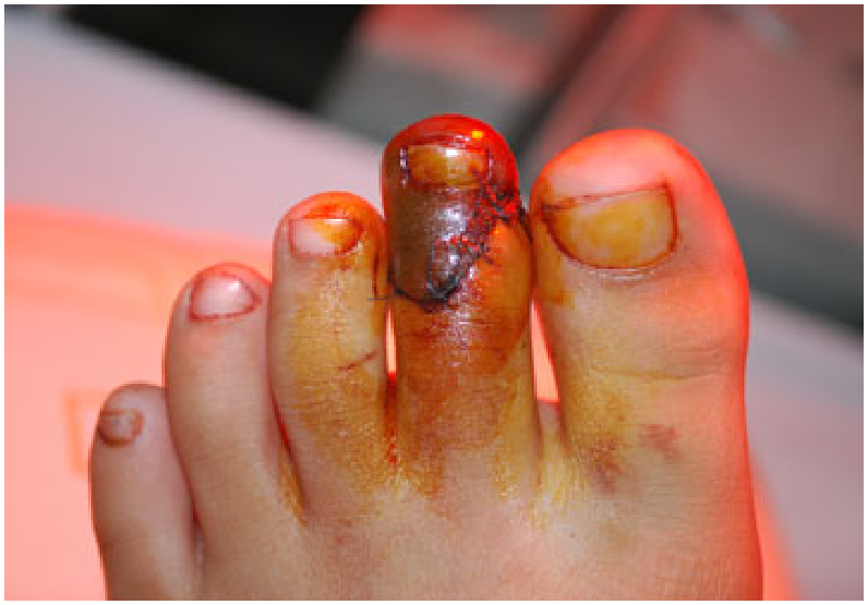 Rách bàn chân - Hình ảnh minh họa