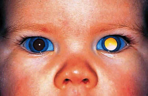 Retinoblastoma - Rb - Hình ảnh minh họa