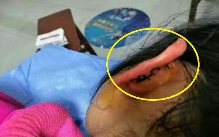 Rách tai - Hình ảnh minh họa