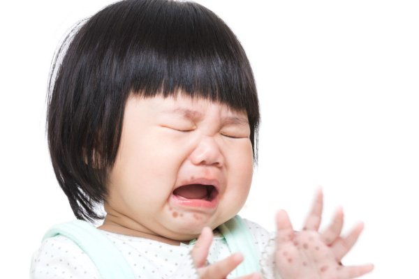 Bệnh tay chân miệng có lây không? Lây qua đường nào? - ảnh 1