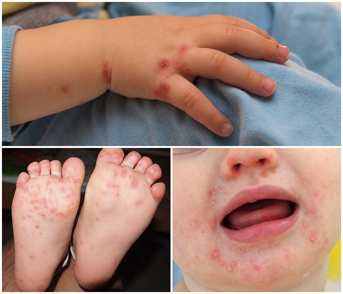Bệnh tay chân miệng có lây không? Lây qua đường nào? - ảnh 2