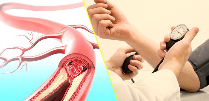 Các triệu chứng điển hình của tăng huyết áp - ảnh 1