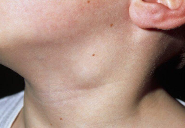 Đau họng, ho, khàn giọng là dấu hiệu của bệnh gì? - ảnh 2